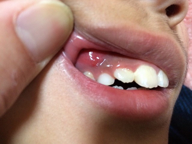 子供が歯が痛いというので見てみたらデカい膿ができていた