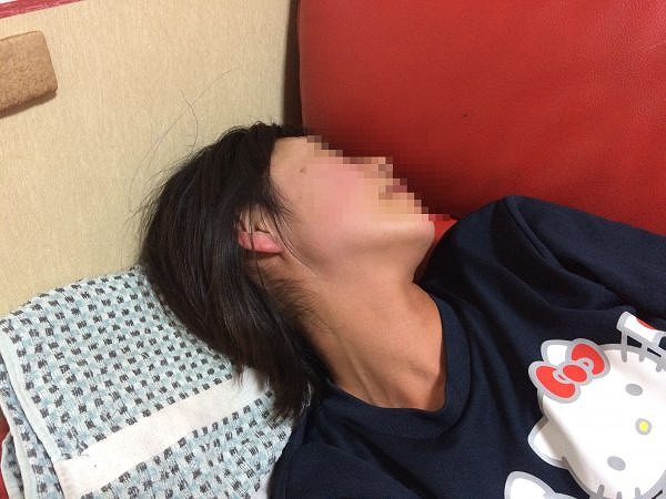 アレルギー 蕁麻疹 写真 鯖